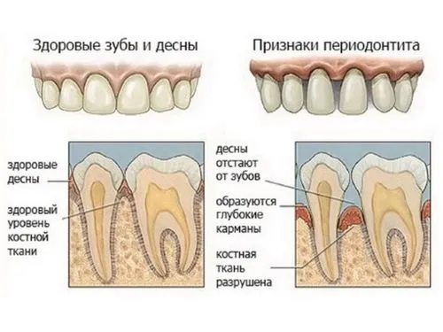 як лікувати свищ на яснах у дітей
