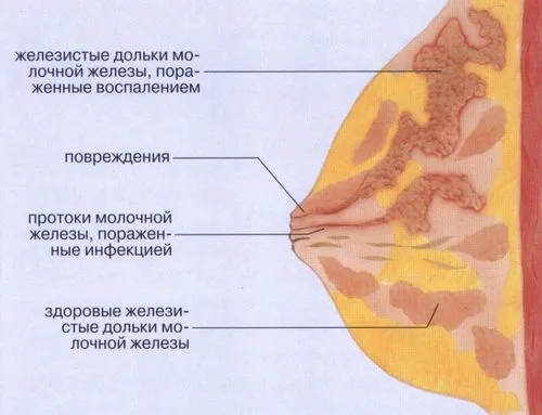 лактостаз що це і як лікувати