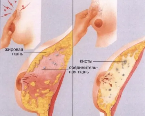лікувати диффузную мастопатію