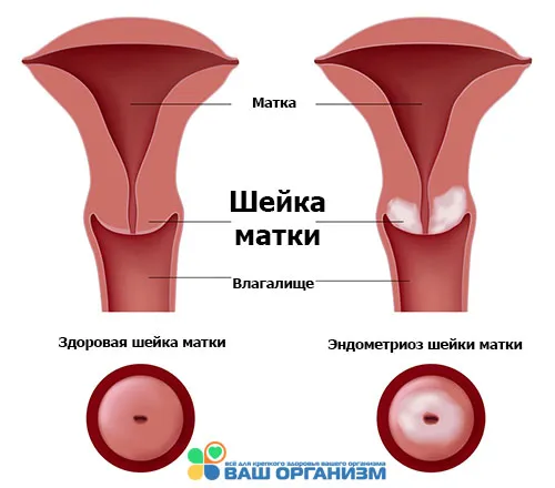 як лікувати ендометріоз шийки матки