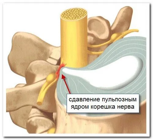 як лікувати хронічний радикуліт