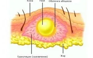 як лікувати хронічний флюс