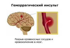 як лікувати геморагічний інсульт