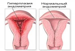 Гиперпластический процес ендометрія: що він собою являє як лікувати гиперпластический ендометрій