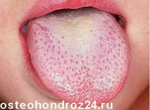 як лікувати запалення язика народними засобами