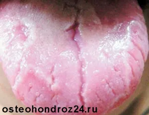 як лікувати запалення язика народними засобами