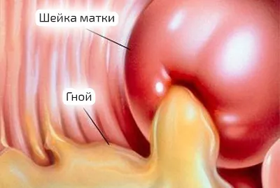 як лікувати трипер у дівчат
