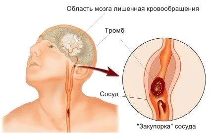 Інсульт та як його лікувати інсульт і як його лікувати