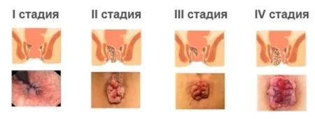як вилікувати геморой дитині