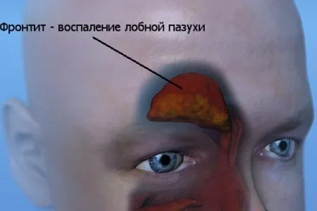 Фронтит - лікування медикаментами і народними засобами фронтит лікування