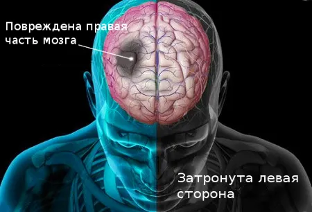 Інсульт та як його лікувати інсульт і як його лікувати