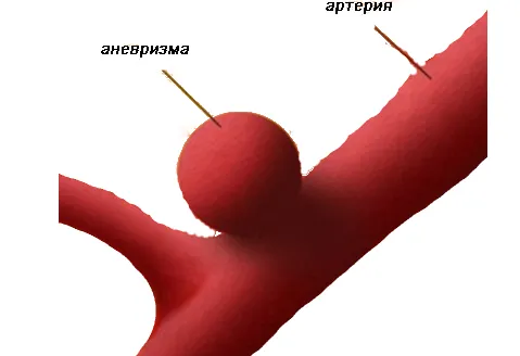 ніж лікувати інсульт головного мозку