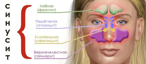 як лікувати бактеріальний синусит