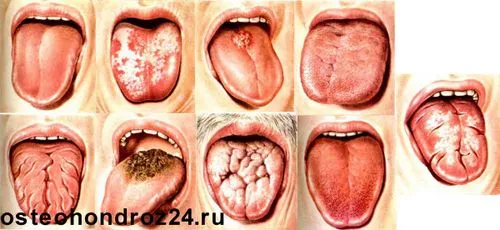 глосит мови симптоми лікування класифікація препарати в домашніх умовах