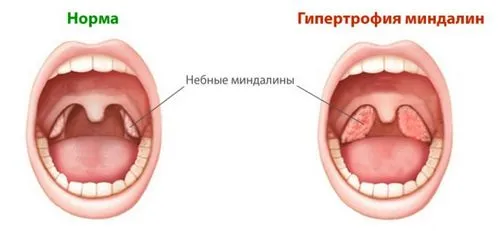 Гіпертрофія піднебінних мигдалин: ступеня і лікування як лікувати мигдалики