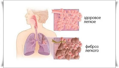 як лікувати фіброз легенів