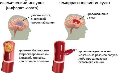 ніж лікувати інсульт головного мозку