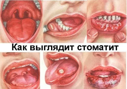 як лікувати стоматит мирамистином