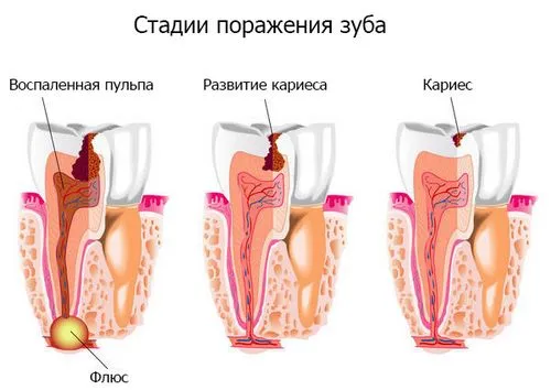 як позбутися від флюсу