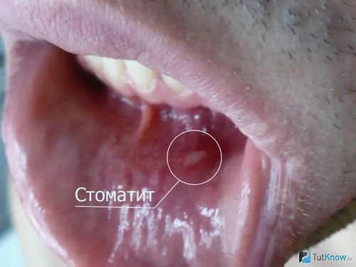 лікувати хронічний стоматит