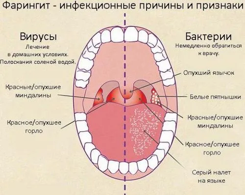 як вилікувати алергічний фарингіт