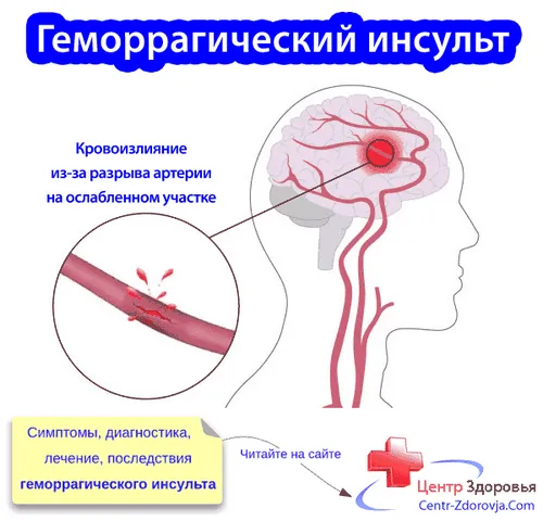 Геморагічний інсульт як лікувати геморагічний інсульт
