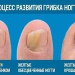 як вилікувати матрицю нігтя