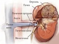 як лікувати якщо застудив нирки