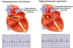як правильно лікувати миготливу аритмію