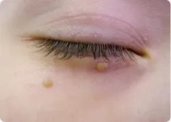 як позбутися від папіломи в домашніх умовах