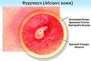 як лікувати фурункул сіллю