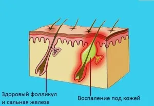 як вилікувати хворі прищі
