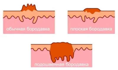 бородавка на руці народні засоби