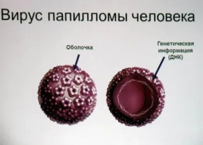 бородавка на п'яті фото
