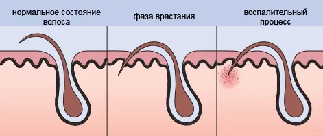 як вилікувати ноги після епілятора