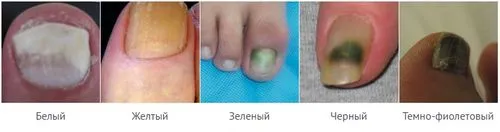 як вилікувати матрицю нігтя
