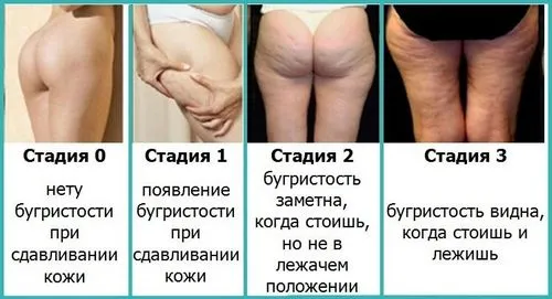 лікувати целюліт зсередини