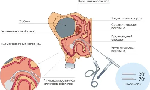 як лікувати фронтит без проколу