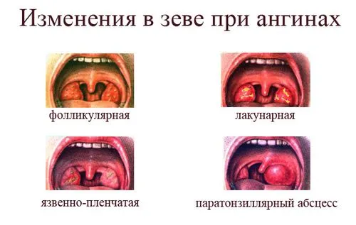 як лікувати гланди при ангіні