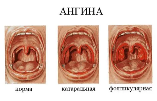 як лікувати гланди при ангіні