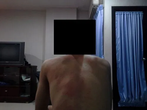 як лікувати висип при вич