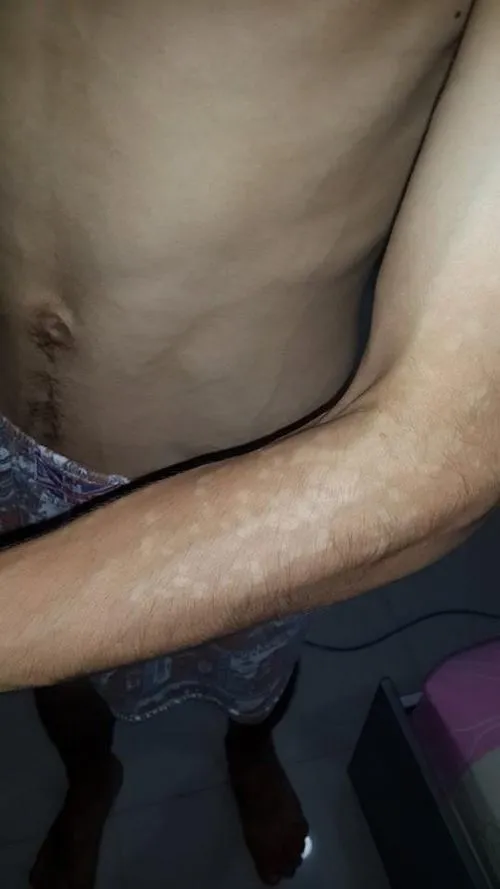 як лікувати висип при вич