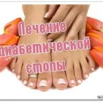 як лікувати мозолі на ногах