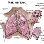 як лікувати рак