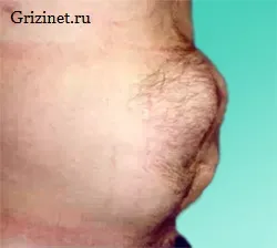 ознаки грижі живота