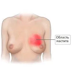як вилікувати мастит без операції