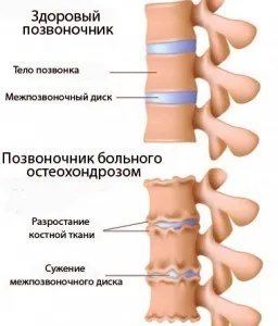 як лікувати остеохондроз народними засобами грудного відділу симптоми методи хребта