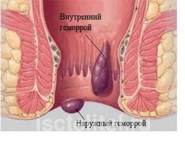 як лікувати геморой травами
