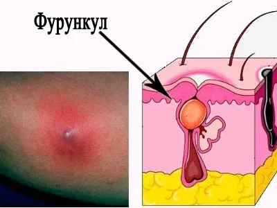 чи можна вилікувати фурункул без хірургічного втручання