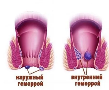 як лікувати геморой мамі